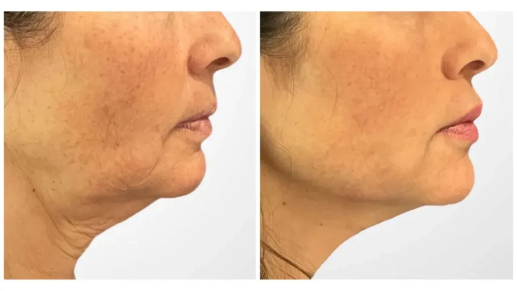 Why the Best Aesthetic Clinic in Dubai Recommends a Thread Lift for Instant Facial Lift