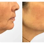 Why the Best Aesthetic Clinic in Dubai Recommends a Thread Lift for Instant Facial Lift