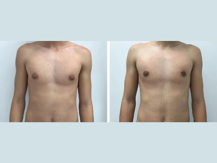 Why the Best Gynecomastia Doctors in Dubai Are in High Demand