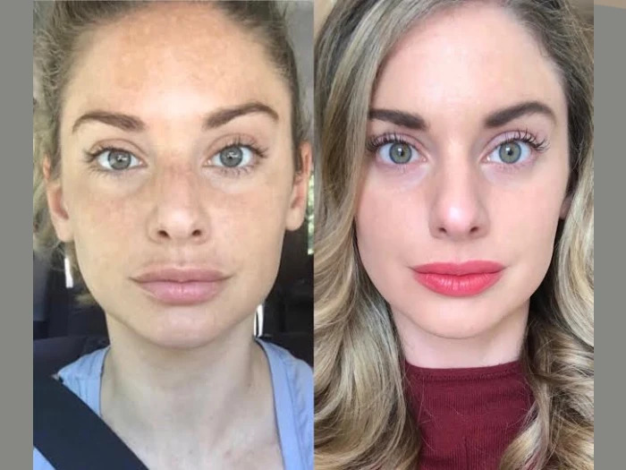 Dubai’s Favorite: Best Aesthetic Clinics in dubai Radiofrequency (RF) Microneedling