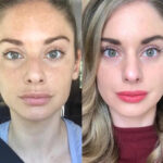 Best Plastic Surgeon in Dubai for Advanced Non-Surgical Radiofrequency (RF) Microneedling