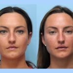 Best Doctors in Dubai Offers Complete Facial Refreshment Using Thread Lift