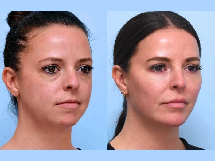 Best Doctors in Dubai Expertise Thread Lift Offers Modern Anti Aging Solutions