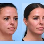 Lift and Contour Your Skin Quickly with a Trusted Thread Lift in Dubai