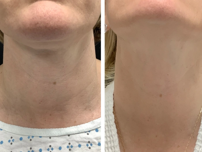 Brighten Your Complexion with Radiofrequency (RF) Microneedling Treatment in Dubai