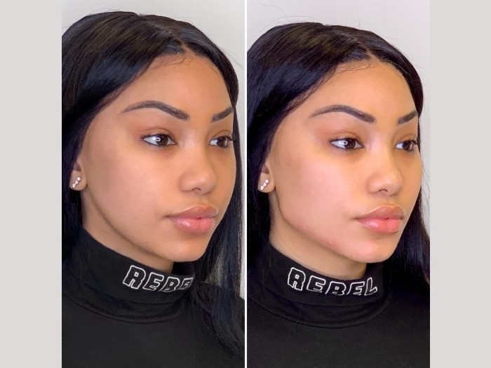 Get Youthful Skin with the Best Plastic Surgeon in Dubai Offering Thread Lift