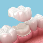 Dental Crowns Dubai