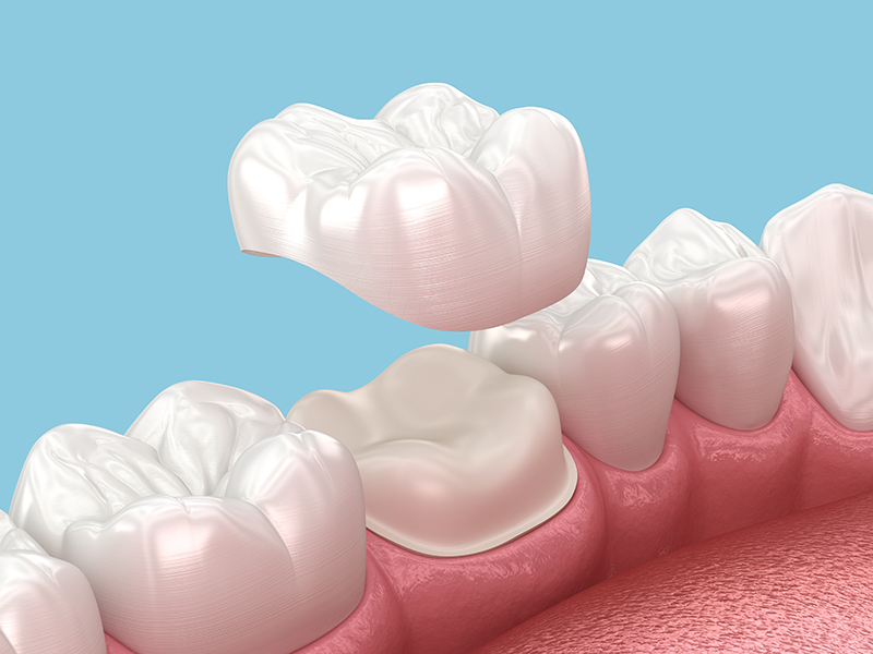 Dental Crowns Dubai