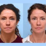 Best Plastic Surgeons in Dubai Lead Modern Thread Lift Techniques
