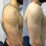 Electrolysis Laser hair removal in dubai