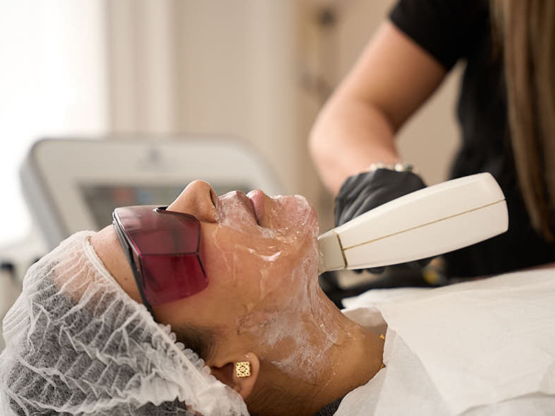 Fractional Laser Treatment in London – Modern Skin Resurfacing Solutions for Smoother Texture, Reduced Scars and Natural Radiance