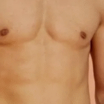 شفط الدهون في جدة