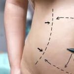 Mini Tummy Tuck in Dubai