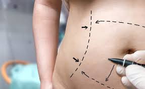 Mini Tummy Tuck in Dubai