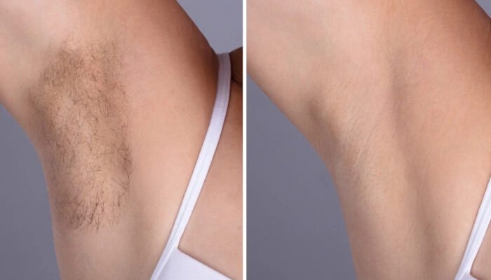 Laser hair removal in Dubai